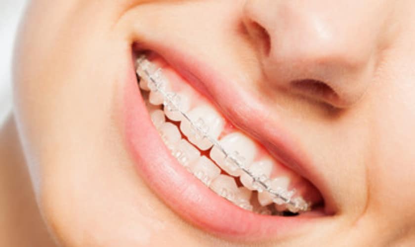 Get Straight Teeth In A Short Period Of Time With Damon Smile Braces