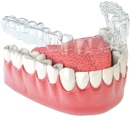 Invisalign