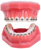 Damon Braces