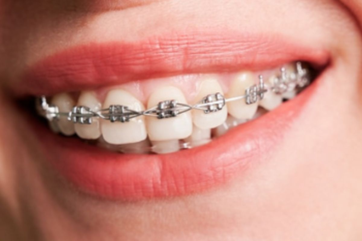 What’s the Right Age to Get Braces for the Best Results?